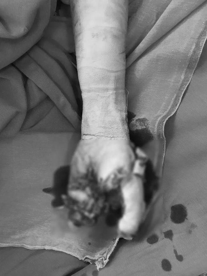 Hãi hùng bé trai 13 tuổi ở Nghệ An bị cắt cụt bàn tay do vừa sạc pin vừa dùng điện thoại-1