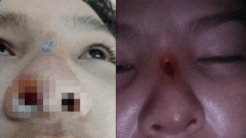 Chi mạnh tay làm đẹp nhưng gặp cơ sở thẩm mỹ chui, cô gái ở Đồng Nai bị biến chứng thủng mũi-1