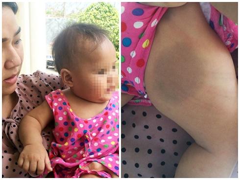 Bé gái 8 tháng tuổi nghi bị mẹ nuôi bạo hành, nhốt trong phòng trọ