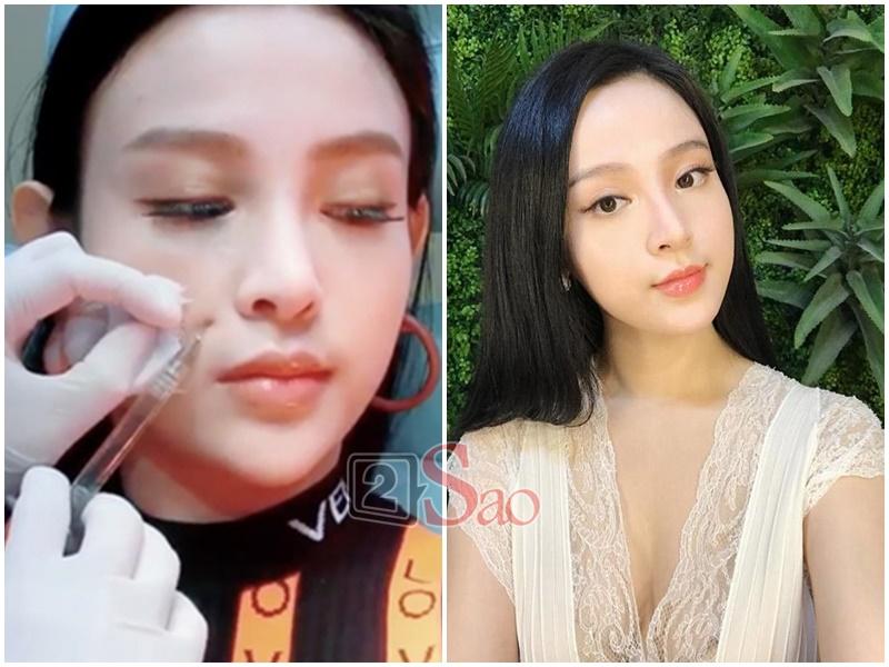 Trâm Anh gây hãi vì khoe cận cảnh tiêm mặt xóa rãnh cười-5