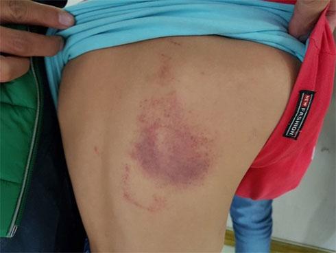 Nghi trộm tiền, bé gái ở Hà Tĩnh bị công an viên đánh bầm tím-2