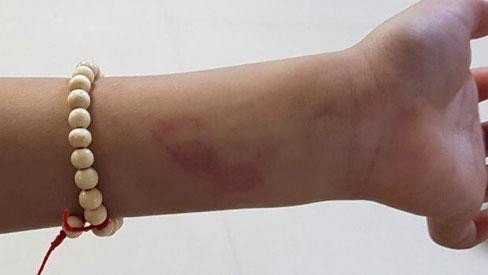 Hải Phòng: Không làm đúng bài tập, học sinh lớp 2 bị cô đánh bầm lưng-2