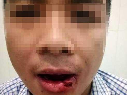 Thầy giáo ném thanh sắt làm nhân viên tòa gãy 5 răng-2