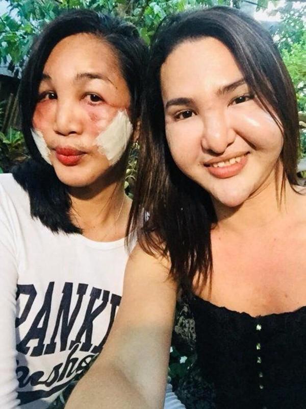 Đôi bạn chuyển giới rủ nhau đi phẫu thuật thẩm mỹ, đến khi bị biến chứng như quỷ dữ cũng phải có đôi có cặp-1