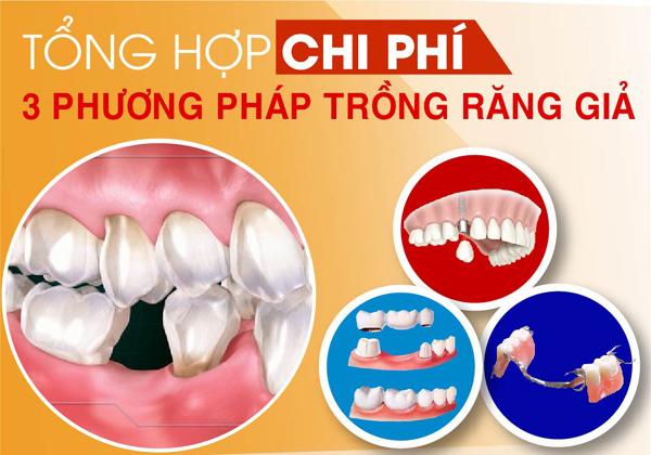 Tặng răng sứ khi trồng răng Implant ở Nha khoa Đông Nam-1