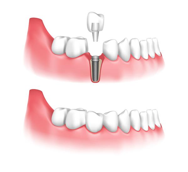 Tặng răng sứ khi trồng răng Implant ở Nha khoa Đông Nam-2