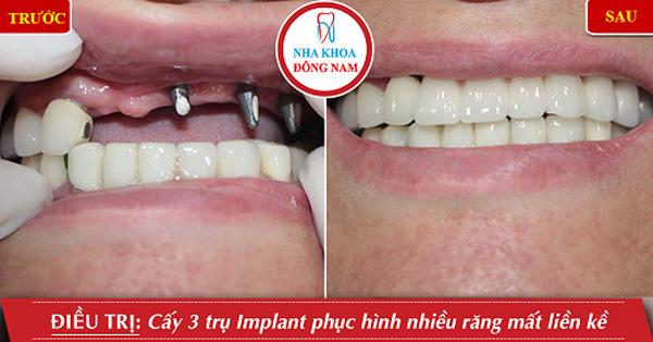 Tặng răng sứ khi trồng răng Implant ở Nha khoa Đông Nam-4