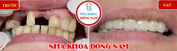 Tặng răng sứ khi trồng răng Implant ở Nha khoa Đông Nam-5