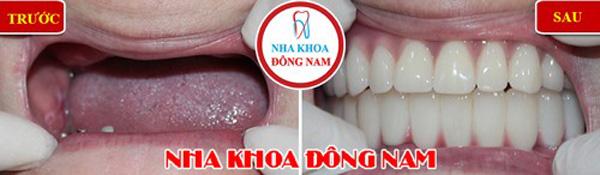 Tặng răng sứ khi trồng răng Implant ở Nha khoa Đông Nam-7