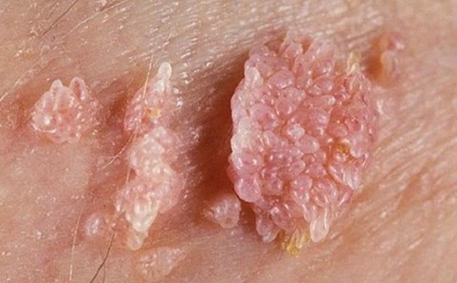 Bà Phạm Thị Yến chùa Ba Vàng tiết lộ bất ngờ về bệnh sùi mào gà-1