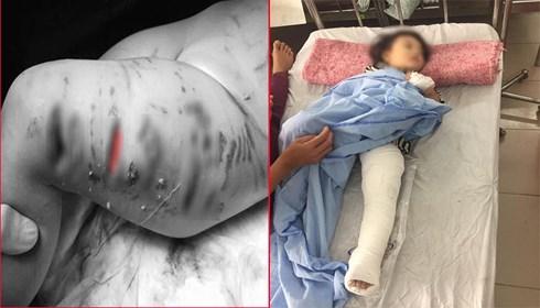 Hà Nội: Hãi hùng bé gái 2 tuổi bị chó Pitbull tấn công-1