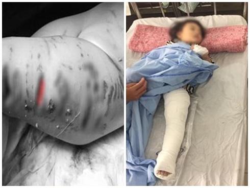 Lại có thêm trường hợp bé 4 tuổi bị chó Pitbull tấn công, đứt khí quản, rách vùng cổ ngực-2