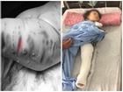 Hà Nội: Hãi hùng bé gái 2 tuổi bị chó Pitbull tấn công