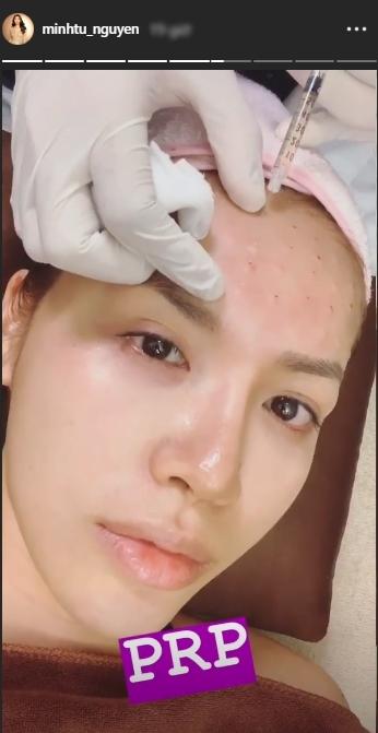 Học theo Kim Kardashian, Minh Tú khiến fan hãi hùng với clip quay cảnh trán đầy những vết tiêm máu-2