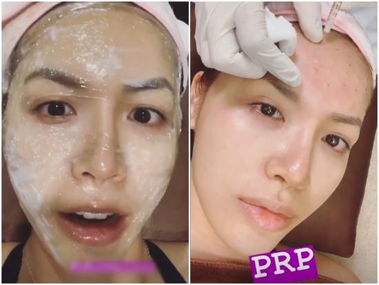 Học theo Kim Kardashian, Minh Tú khiến fan hãi hùng với clip quay cảnh trán đầy những vết tiêm máu