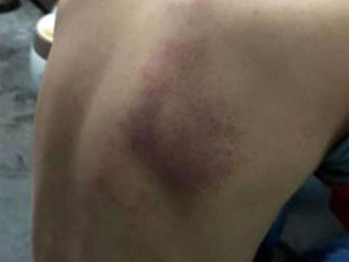 Đánh học trò tím lưng, cô giáo Hải Phòng bị phạt 5 triệu đồng