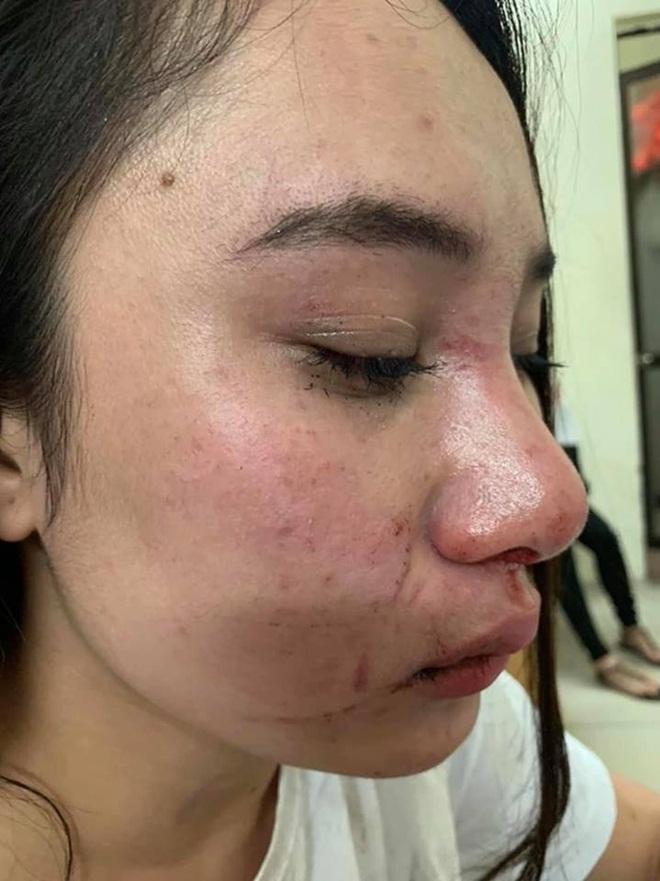 Cô gái bị đánh ghen ở Bà Triệu công khai vết thương, khẳng định oan ức và yêu cầu đưa bằng chứng con giáp 13-3