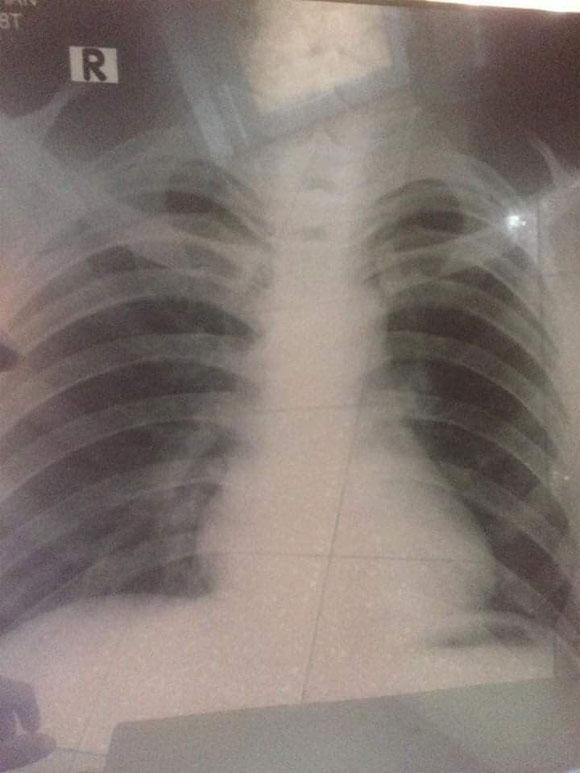 Chia sẻ đẫm lệ về sự hối hận muộn màng của chàng trai trẻ bị ung thư phổi vì hút thuốc lá từ sớm-2