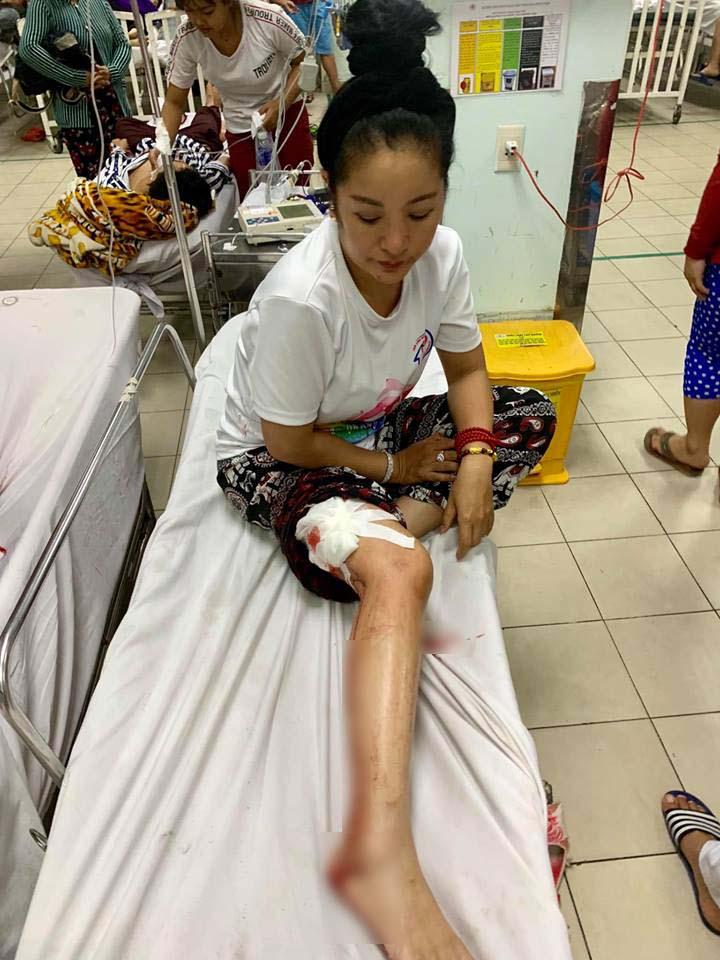 Danh hài Thúy Nga tai nạn, máu chảy đầm đìa phải cấp cứu khâu gần 10 mũi trên bắp đùi-1