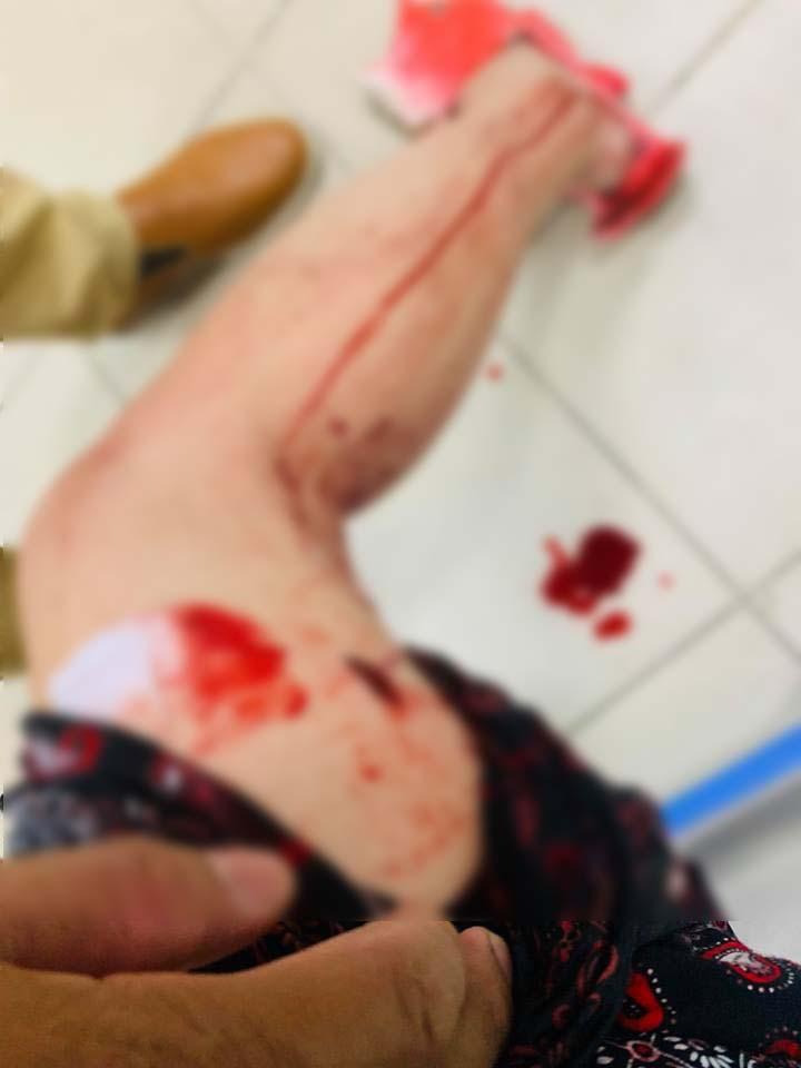 Danh hài Thúy Nga tai nạn, máu chảy đầm đìa phải cấp cứu khâu gần 10 mũi trên bắp đùi-2