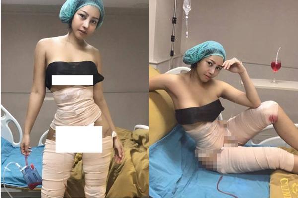 Hotgirl đình đám bất ngờ công khai loạt ảnh phẫu thuật thẩm mỹ để có vòng eo con kiến-2