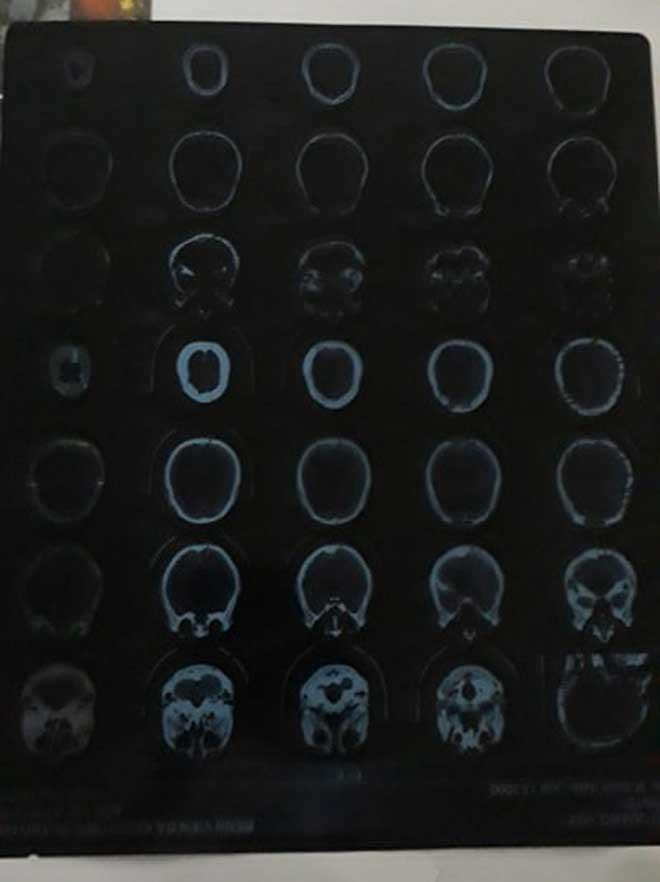 Nữ sinh bị đánh hội đồng ở Quảng Ninh: Nam thanh niên đi cùng cũng bị đánh nhập viện-4