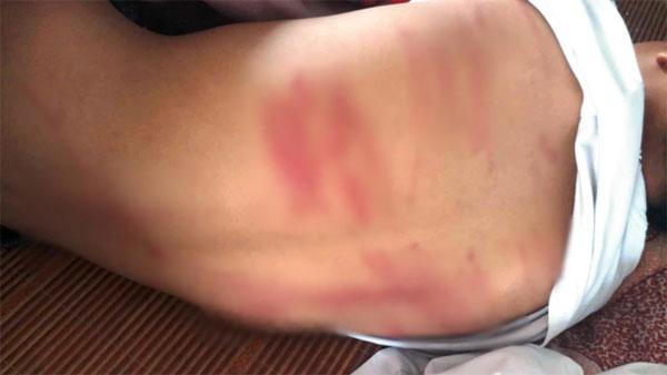 PHẪN NỘ: Học sinh lớp 8 bị bố đánh tím bầm hết người, vừa đến lớp thì ngất xỉu phải đưa đi cấp cứu-1