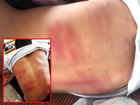 Sốc: Bé gái 14 tuổi bị ung thư cổ tử cung giai đoạn cuối-3