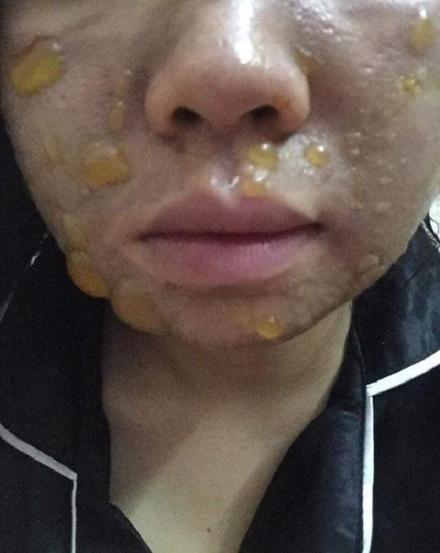 Sốc trước gương mặt của cô gái trẻ trước 15 ngày cưới khi tin vào mỹ phẩm xịn-2