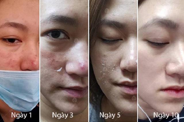 Sốc trước gương mặt của cô gái trẻ trước 15 ngày cưới khi tin vào mỹ phẩm xịn-7