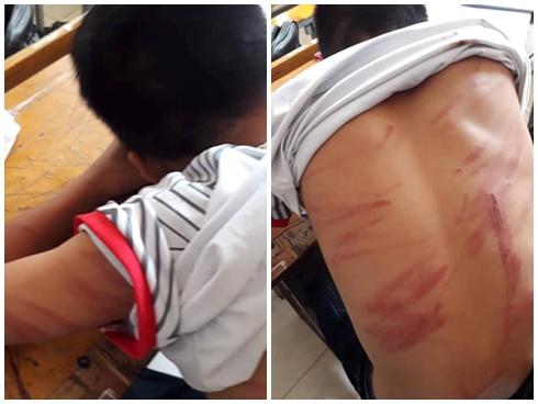 Bé 7 tuổi bị bố bạo hành: Người mẹ đau đớn gửi đơn đến BV Việt Đức-2