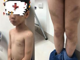 SỐC: Mẹ ruột tố con trai bị mẹ kế dùng dép và gậy đánh tím đen cả người SỐC: Mẹ ruột tố con trai bị mẹ kế dùng dép và gậy đánh tím đen cả người
