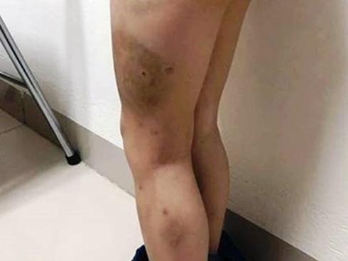 Bé 7 tuổi bị bố bạo hành: Người mẹ đau đớn gửi đơn đến BV Việt Đức