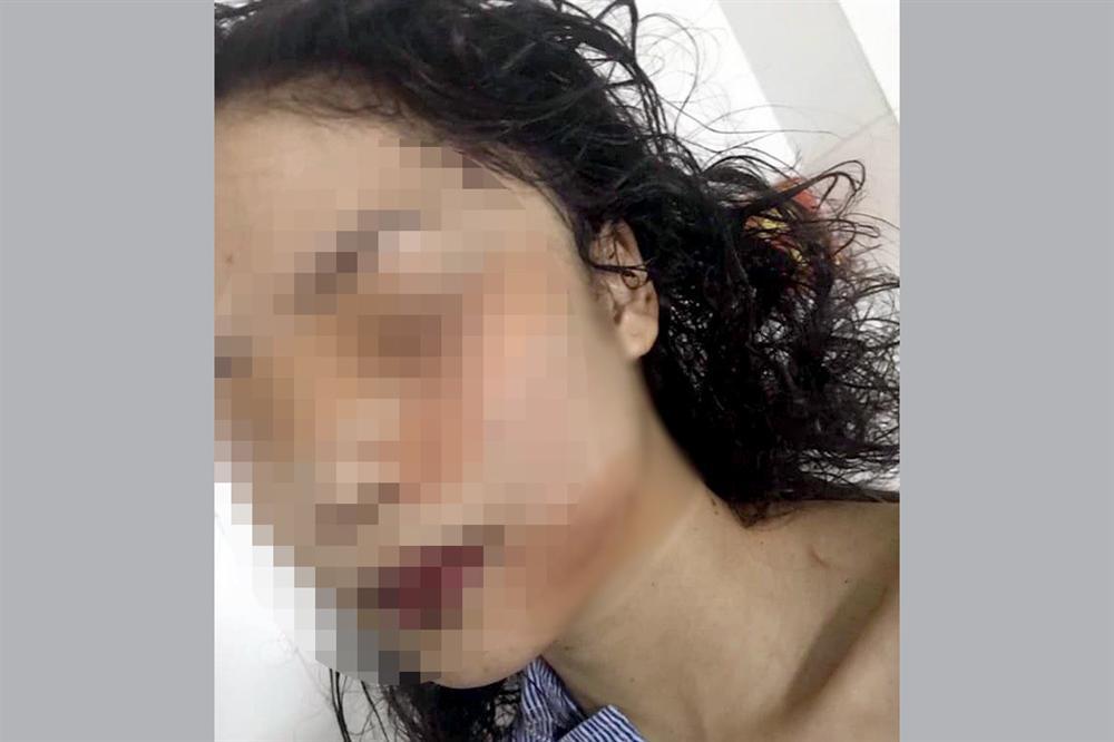 Cô gái 18 ở Bắc Ninh bị rạch mặt trong đêm, khâu 60 mũi-1