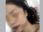 Cô gái 18 ở Bắc Ninh bị rạch mặt trong đêm, khâu 60 mũi