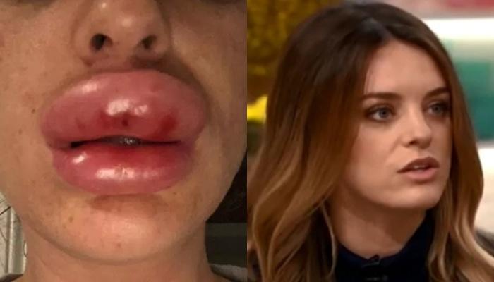 Tiêm botox tại nhà, đôi môi của cô gái trẻ sưng gấp 4 lần bình thường-1