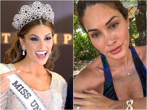 Đồi mồi phủ kín mặt - ngực - lưng nhưng cách Hoa hậu Hoàn vũ 2013 yêu thương bản thân khiến ai nấy đều ngưỡng mộ