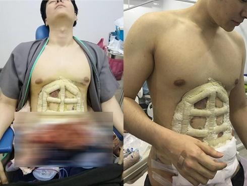 Các chàng bụng bia đang phát cuồng với xu hướng phẫu thuật tạo 6 múi-5