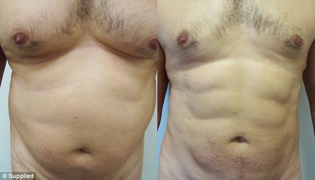 Các chàng bụng bia đang phát cuồng với xu hướng phẫu thuật tạo 6 múi-3