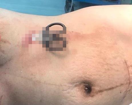 Cứu sống sản phụ tự đâm thấu tim vì trầm cảm-1