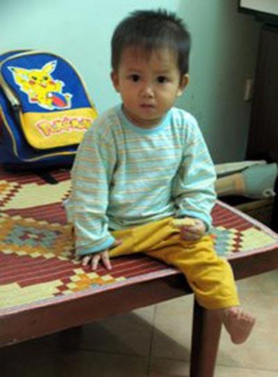 Ngoại hình thay đổi bất ngờ của bé sơ sinh mất chân, bị mẹ bỏ rơi trong vườn hoang sau 13 năm-2