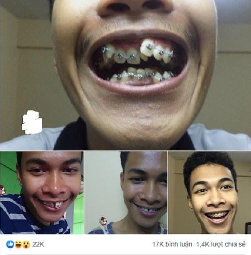 Ngỡ ngàng trước sự lột xác vi diệu nhờ niềng răng, dung mạo thay đổi 180 độ-1