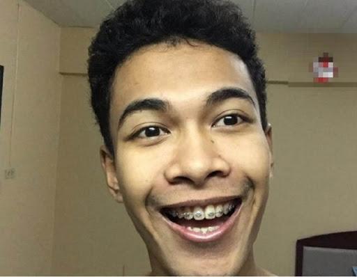 Ngỡ ngàng trước sự lột xác vi diệu nhờ niềng răng, dung mạo thay đổi 180 độ-2