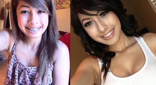 Ngỡ ngàng trước sự lột xác vi diệu nhờ niềng răng, dung mạo thay đổi 180 độ-3