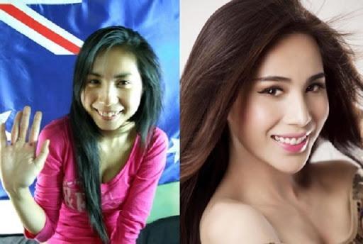 Ngỡ ngàng trước sự lột xác vi diệu nhờ niềng răng, dung mạo thay đổi 180 độ-4