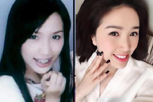 Ngỡ ngàng trước sự lột xác vi diệu nhờ niềng răng, dung mạo thay đổi 180 độ-7