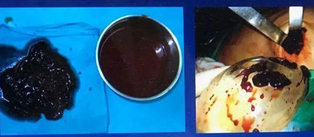 Ngực nữ doanh nhân Việt 33 tuổi sưng to như muốn nổ tung sau thẩm mĩ-1