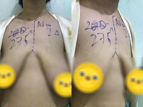 Mẹ trẻ gây ám ảnh với bộ ngực chảy xệ, da bụng rạn nứt tung tóe sau sinh