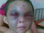 Thực hư thông tin bé trai ở Thanh Hóa bị dì ghẻ đánh đập thâm tím mặt vì… nhớ mẹ