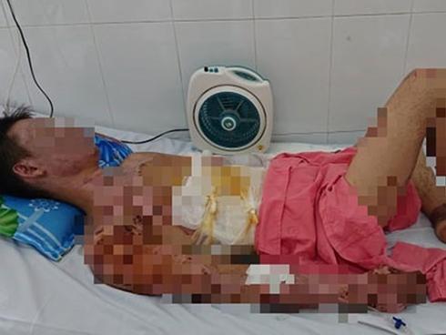 Thương tâm: Chuẩn bị ăn cơm thì nổ bình gas, cả gia đình 4 người bỏng nặng